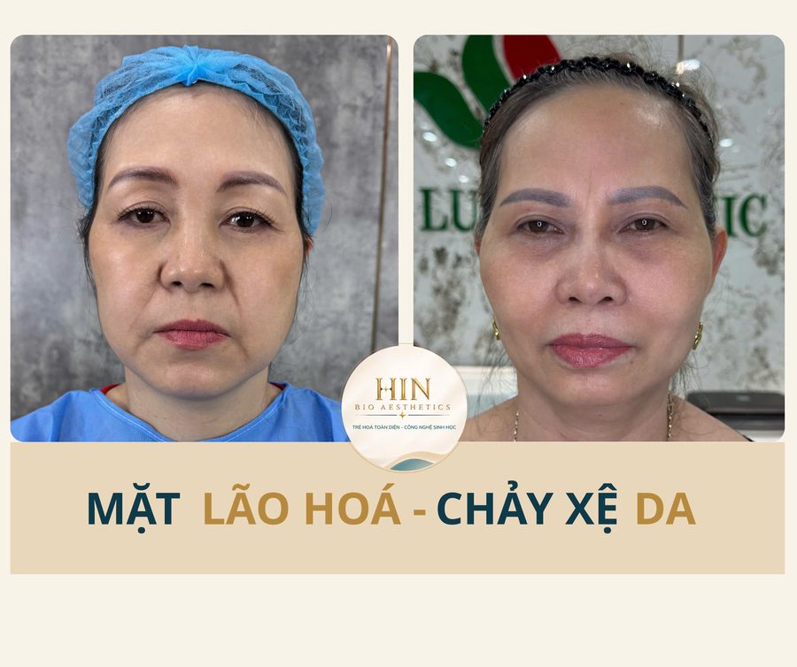 Mặt lão hoá, chảy xệ — HIN BIO AESTHETICS