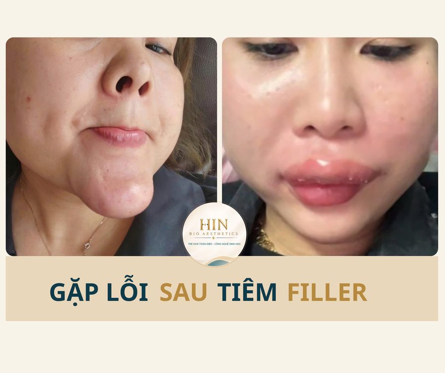 Gặp lỗi sau tiêm filler — HIN BIO AESTHETICS