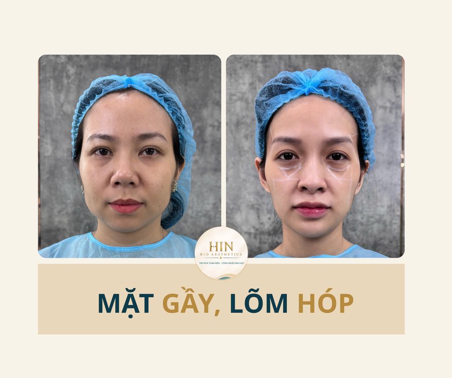 Mặt gầy, lõm hóp — HIN BIO AESTHETICS
