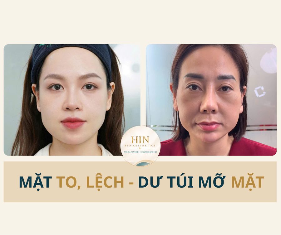 Mặt to, lệch, dư mỡ — HIN BIO AESTHETICS