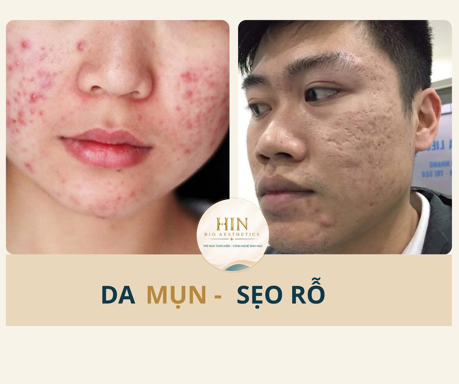 Da mụn, sẹo rỗ — HIN BIO AESTHETICS