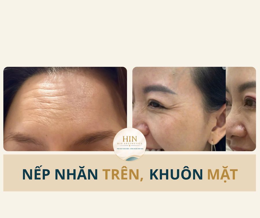 Nếp nhăn trán, đuôi mắt — HIN BIO AESTHETICS