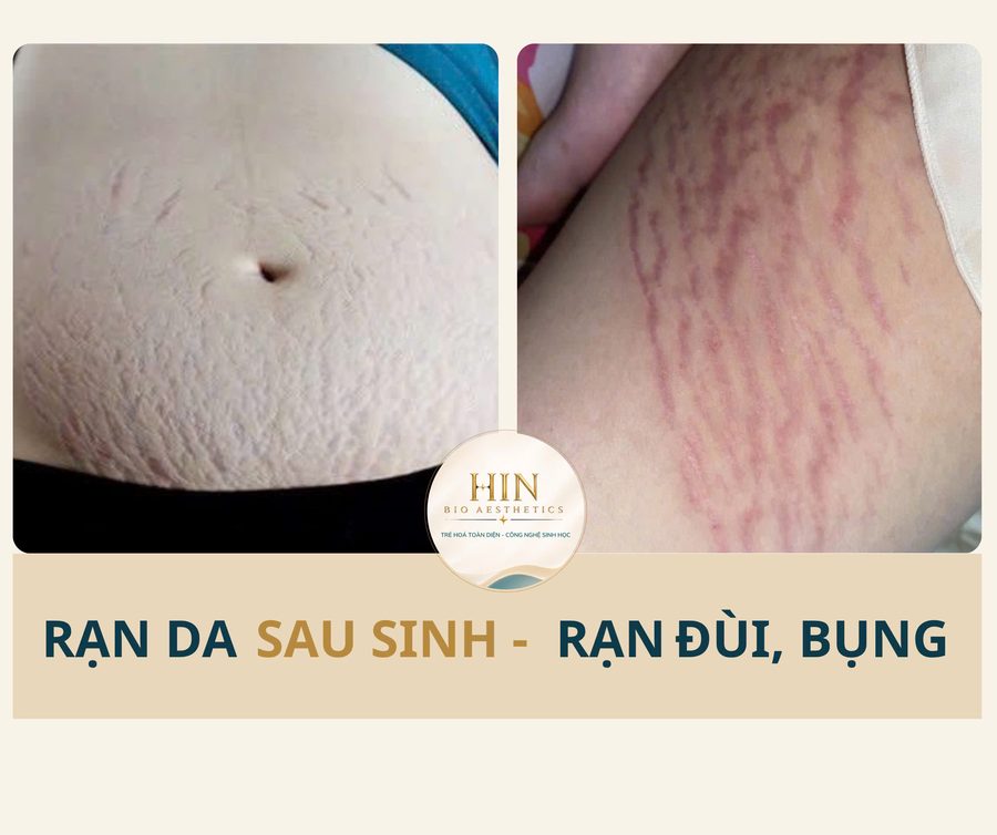 Rạn da sau sinh — HIN BIO AESTHETICS