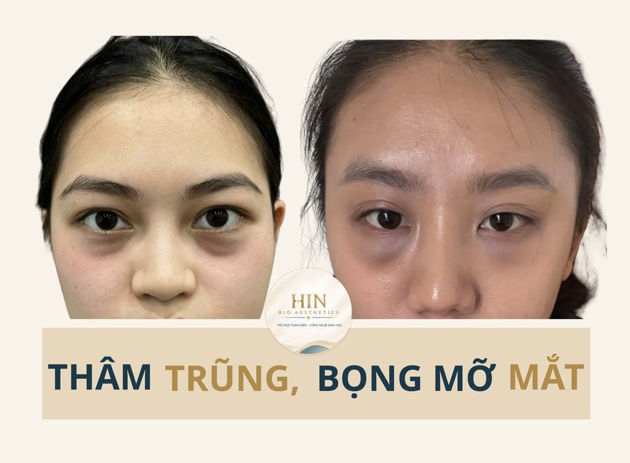 Thâm, trũng, bọng mỡ mắt — HIN BIO AESTHETICS