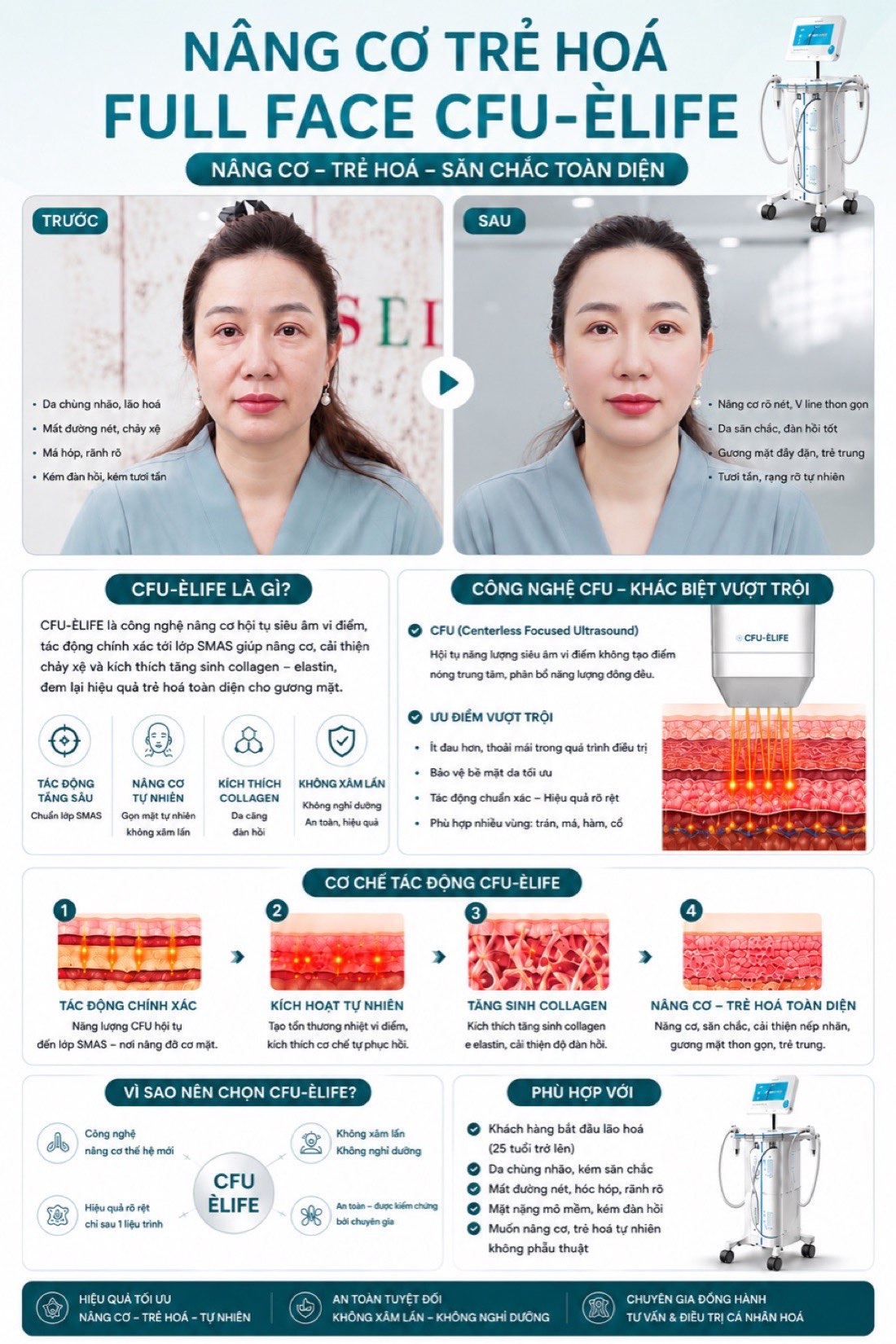 Cơ chế công nghệ nâng cơ CFU-Èlife — hội tụ siêu âm vi điểm tác động lớp SMAS, kết quả trước sau thực tế
