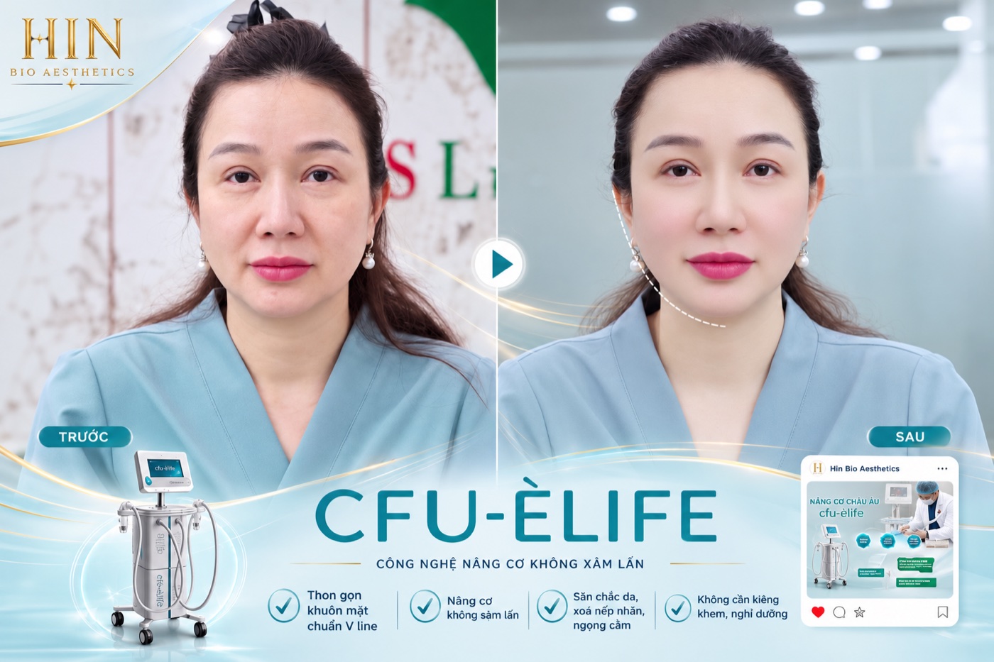 Nâng cơ CFU-Èlife — không kim, không phải HIFU