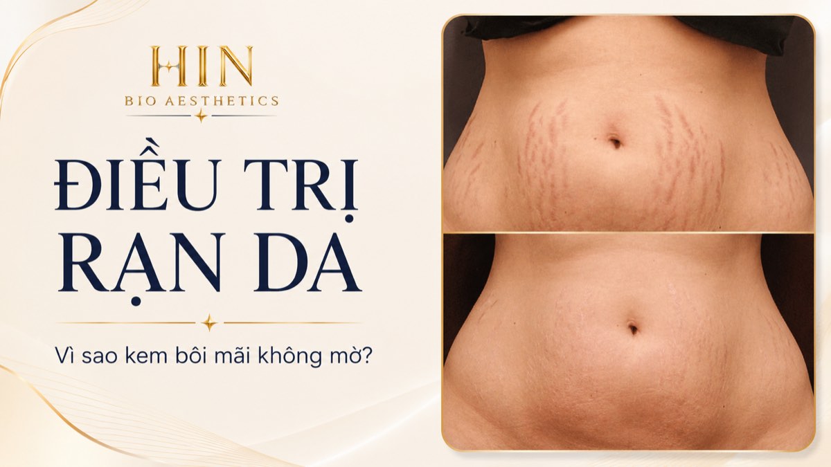Điều trị rạn da tại HIN BIO AESTHETICS — vì sao kem bôi mãi không mờ