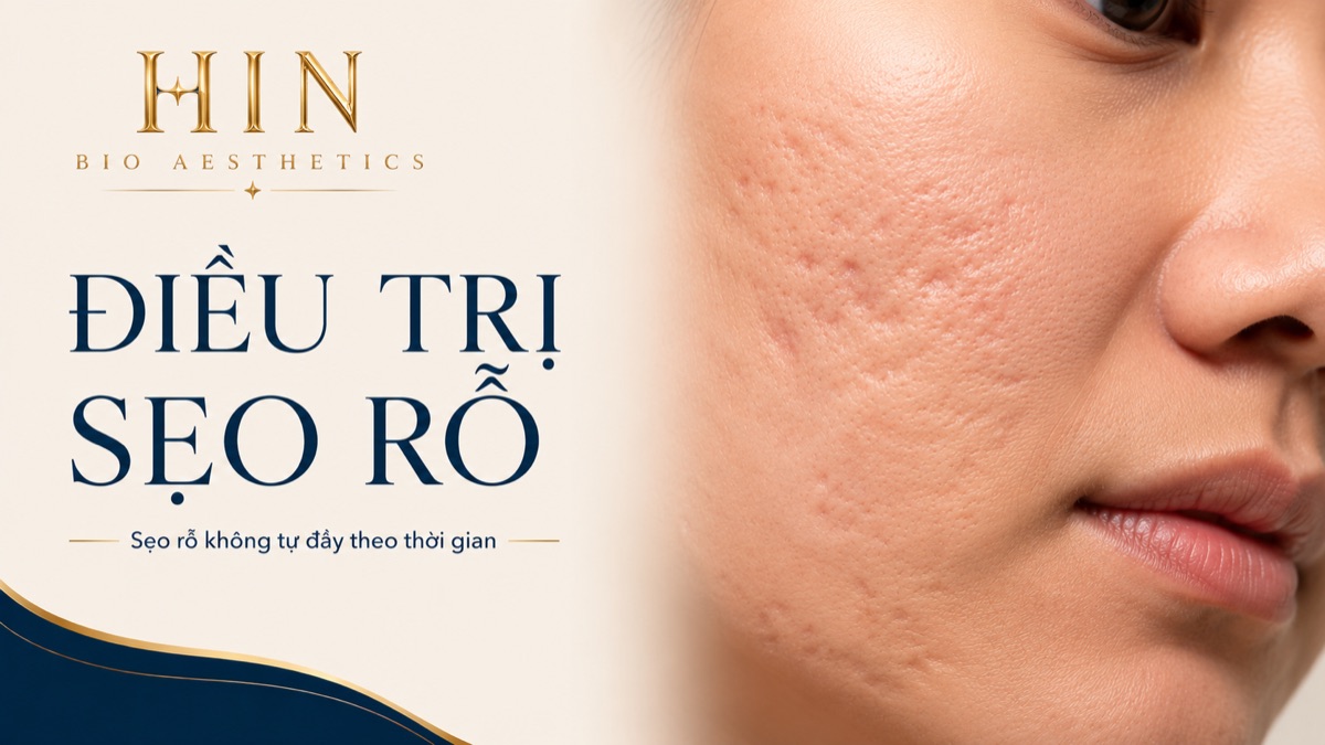 Điều trị sẹo rỗ sau mụn tại HIN BIO AESTHETICS — sẹo rỗ không tự đầy theo thời gian