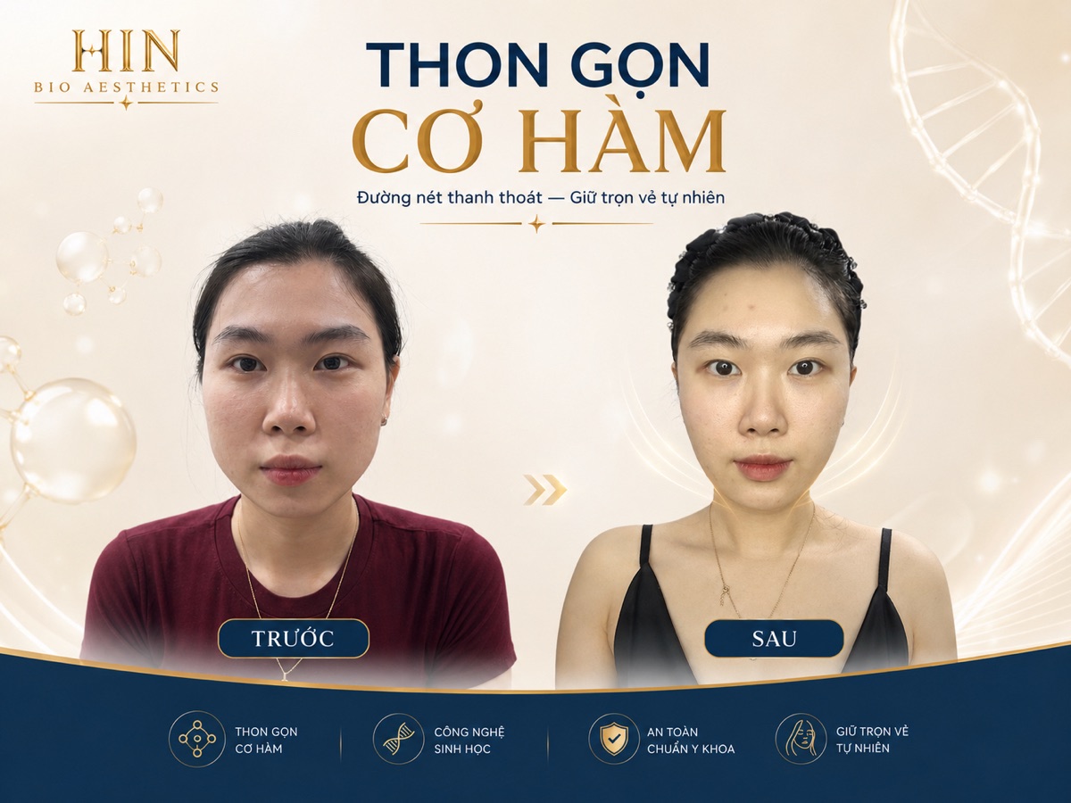 Khách hàng thon gọn cơ hàm tại HIN BIO — trước và sau, đường nét thanh thoát biểu cảm tự nhiên