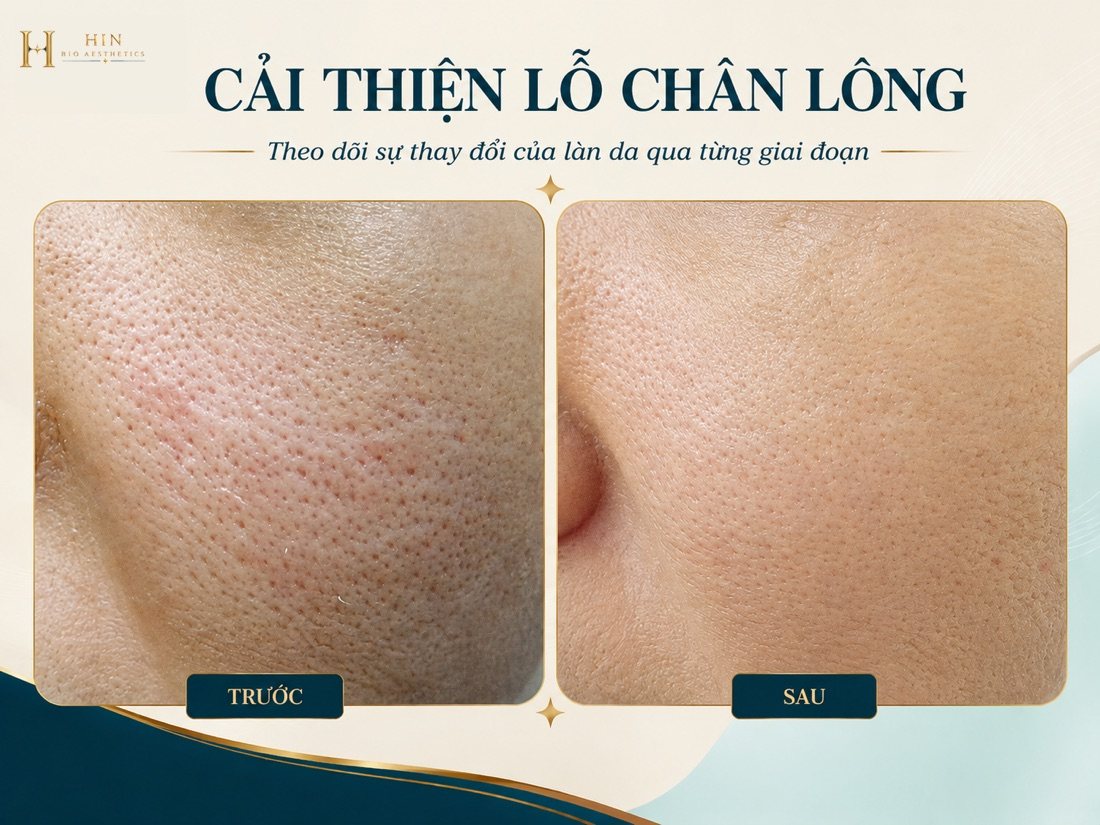 Cải thiện lỗ chân lông tại HIN BIO AESTHETICS — kết cấu da trước và sau liệu trình, ảnh khách hàng thực tế