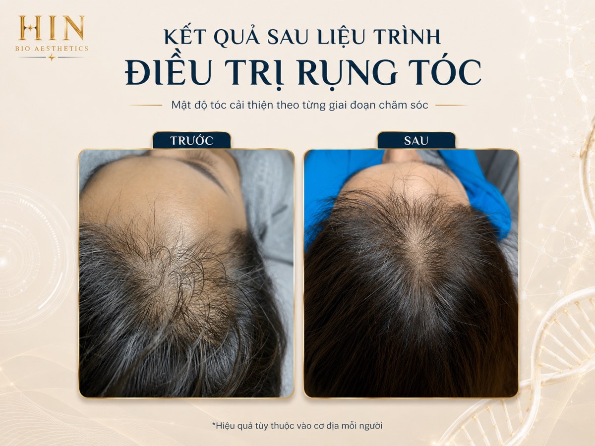 Kết quả điều trị rụng tóc tại HIN BIO AESTHETICS — mật độ tóc cải thiện trước và sau liệu trình, ảnh khách hàng thực tế