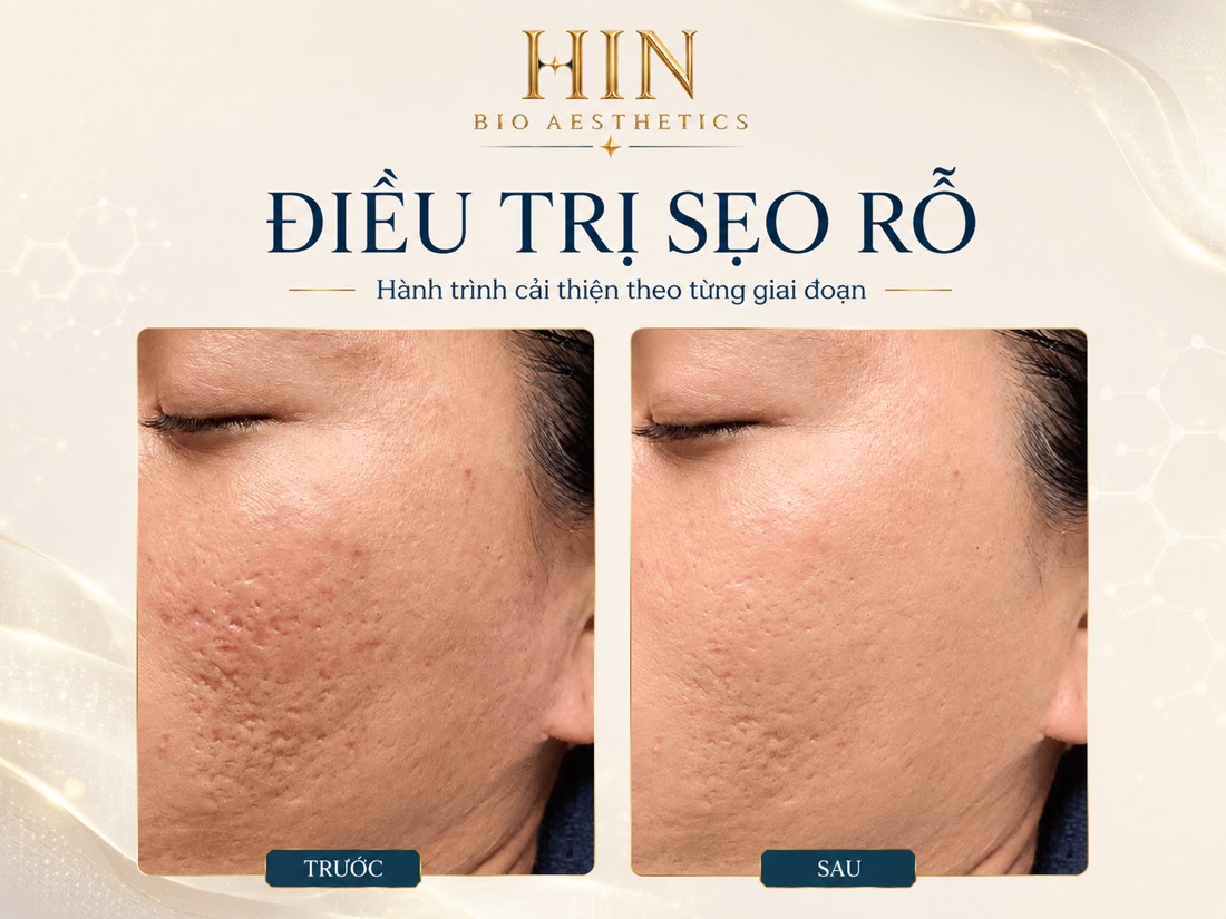 Kết quả điều trị sẹo rỗ tại HIN BIO AESTHETICS — bề mặt da trước và sau liệu trình, ảnh khách hàng thực tế
