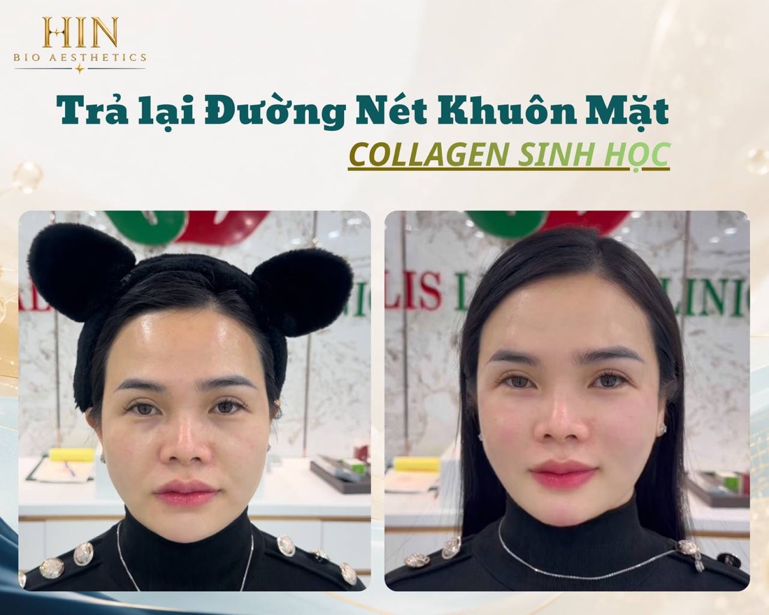Khách hàng lấy lại đường nét khuôn mặt bằng Collagen sinh học tại HIN BIO — ảnh trước và sau