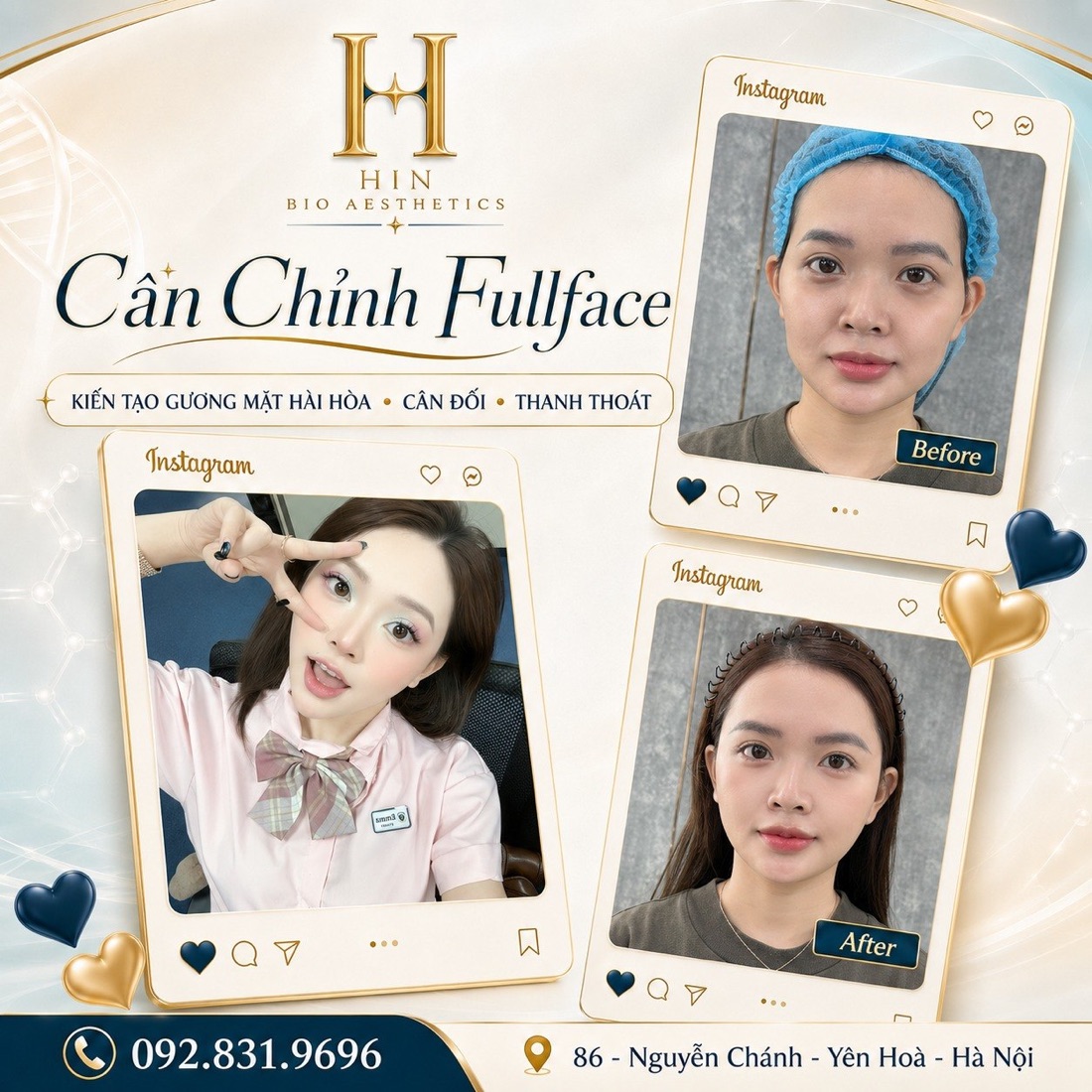 Khách hàng cân chỉnh fullface tại HIN BIO — gương mặt hài hòa cân đối thanh thoát, ảnh before after và selfie