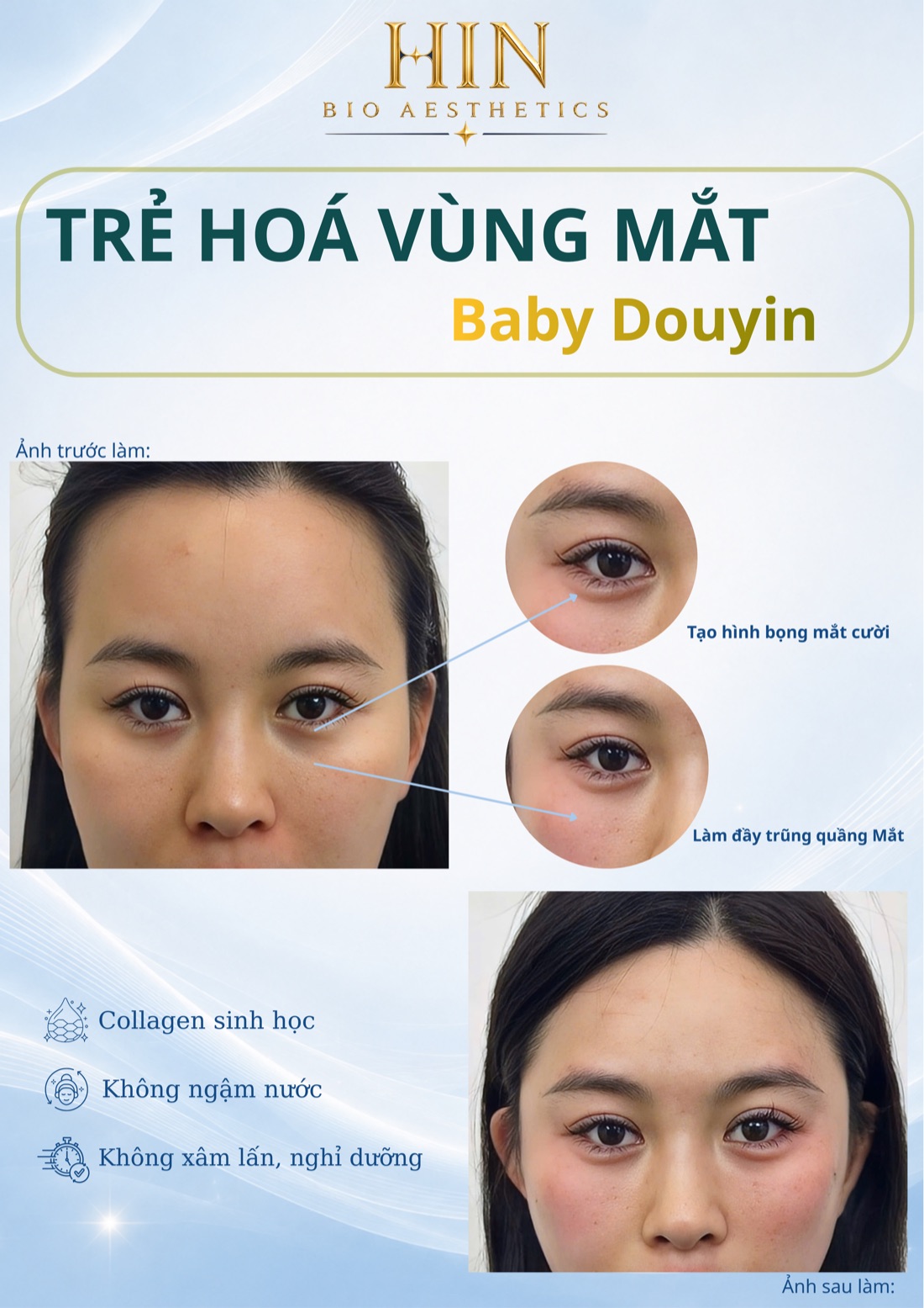 Khách hàng trẻ hóa vùng mắt Baby Douyin tại HIN BIO — tạo hình bọng mắt cười, làm đầy trũng quầng mắt, ảnh trước và sau
