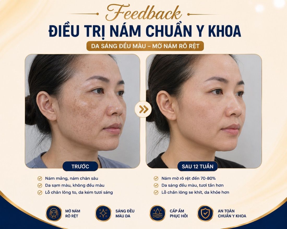 Kết quả điều trị nám theo phác đồ tại HIN BIO AESTHETICS sau 12 tuần — nám mảng và nám chân sâu mờ rõ