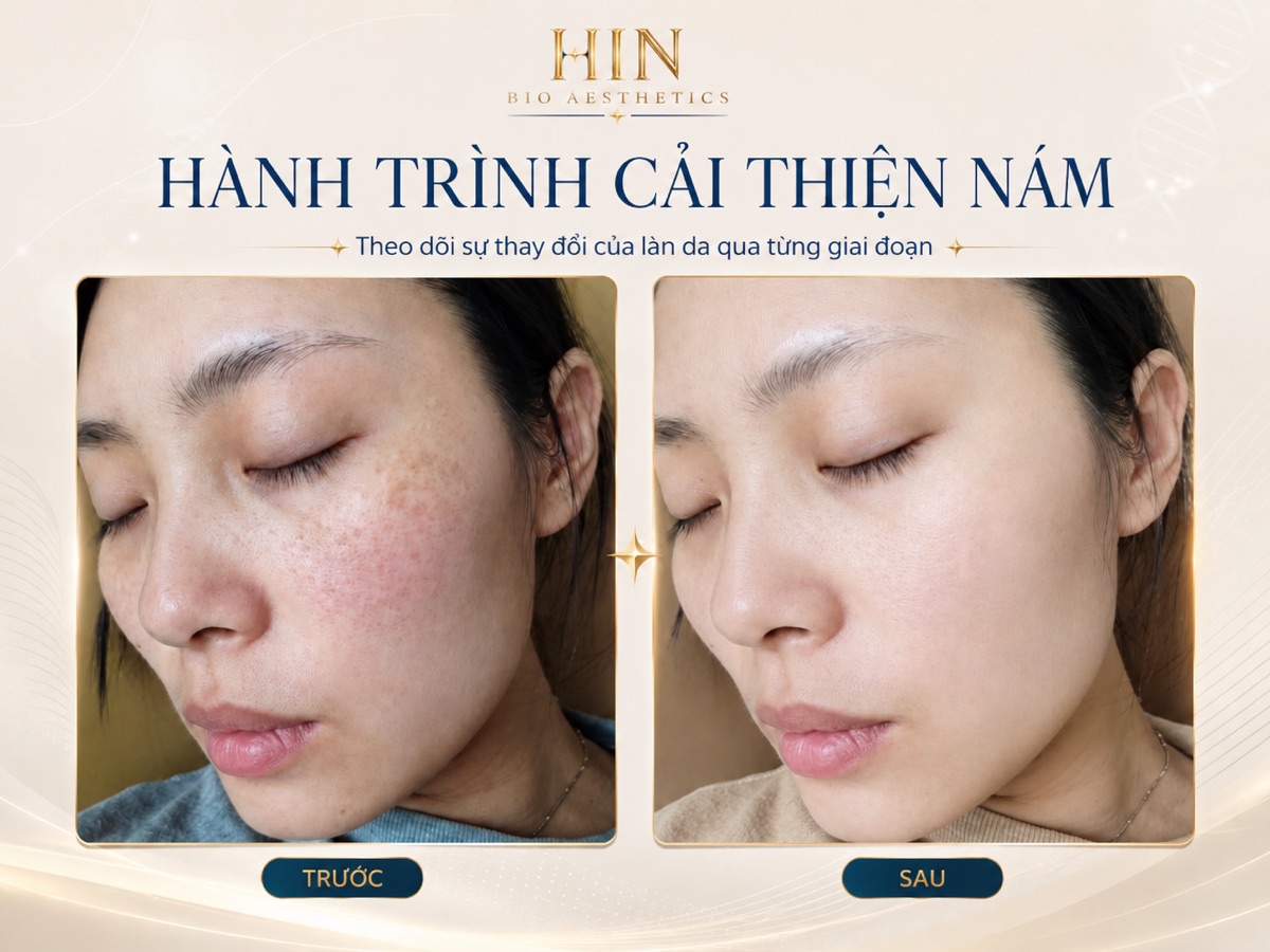 Khách hàng điều trị nám tại HIN BIO — trước và sau, da sáng đều màu