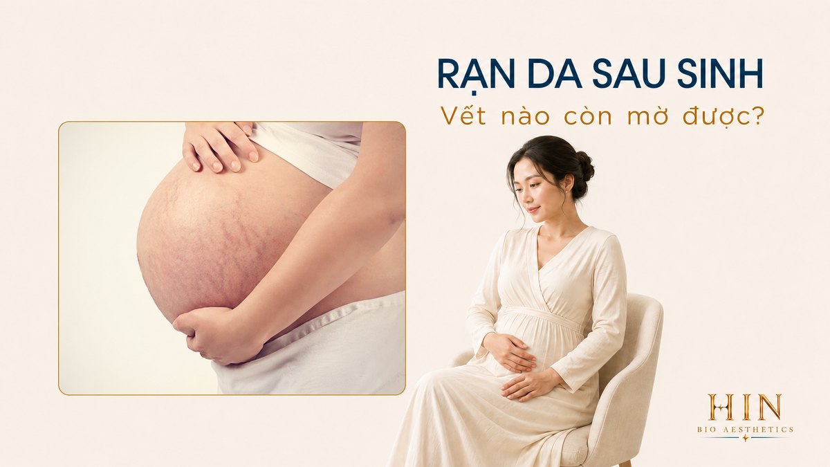 Rạn da sau sinh: vết nào còn mờ được, vết nào không?