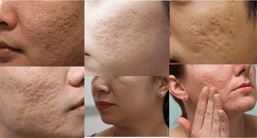 Các dạng sẹo rỗ sau mụn: sẹo đáy nhọn, sẹo đáy vuông và sẹo lượn sóng trên má