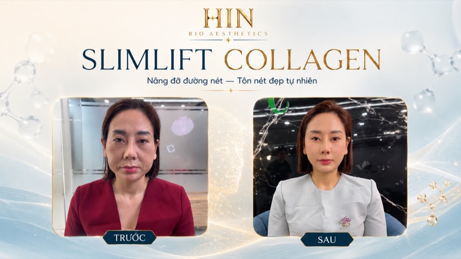 SLIMLIFT COLLAGEN — nâng cơ trẻ hóa, kết quả khách hàng thực tế tại HIN BIO AESTHETICS