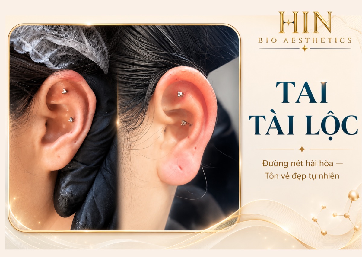 Khách hàng tạo hình tai Tài Lộc tại HIN BIO — trước và sau