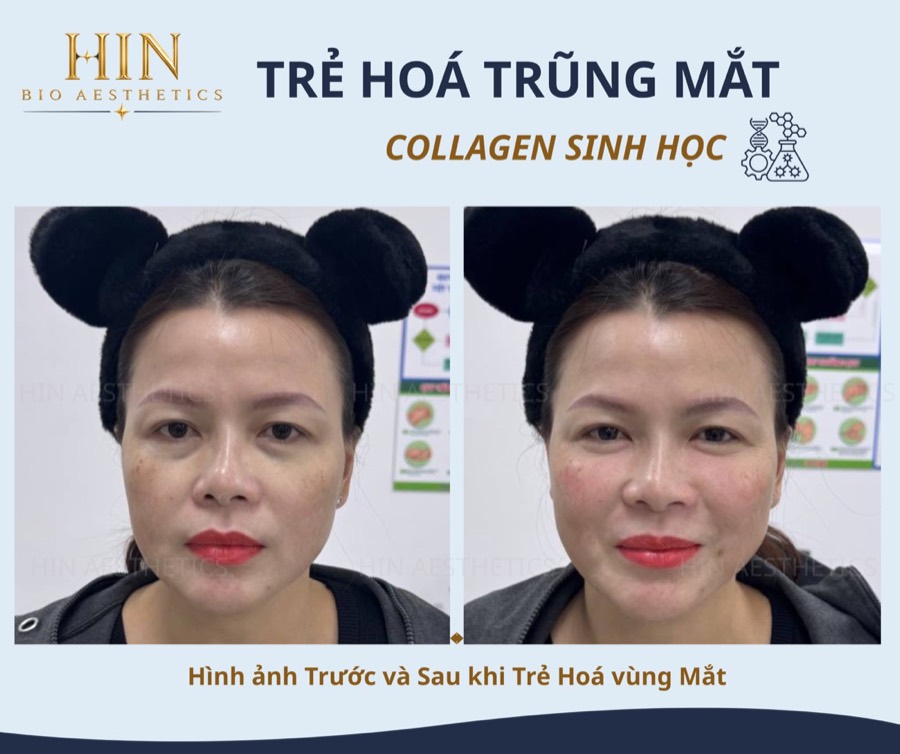 Trẻ hóa trũng mắt Collagen sinh học — kết quả khách hàng thực tế