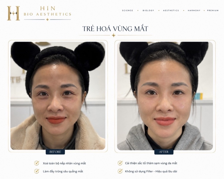 Kết quả trẻ hóa vùng mắt trước và sau tại HIN BIO AESTHETICS