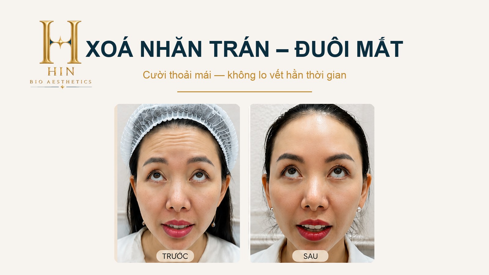 Khách hàng xóa nhăn trán và đuôi mắt tại HIN BIO — trước và sau, cười thoải mái không lo vết hằn